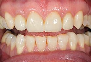 The image shows a close-up of a person s mouth with teeth that appear to be discolored or stained, possibly due to smoking or poor oral hygiene, set against a neutral background.